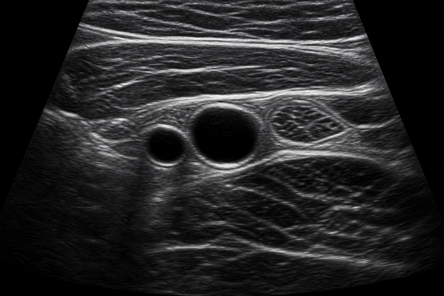 Imagem ultrassonográfica educacional simulada do nervo femoral na região inguinal, sem marcações.